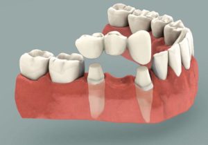 dental bridge penrith