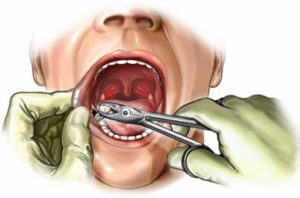 emergency wisdom tooth removal