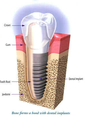 dental implants penrith